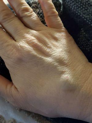 Initial photo of the back of my right hand, after MRI with and without contrast showing swelling and bruising.