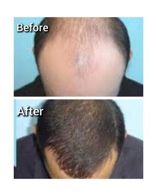 Hair Transplant