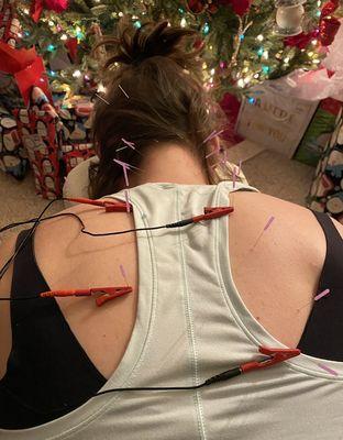 Dry needling works to decrease muscle spasming, increase circulation, and improve pain.