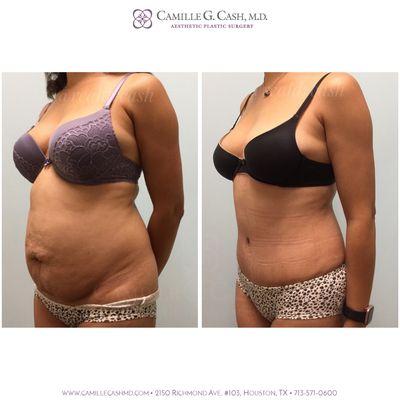 Before and 6 weeks after a tummy tuck with liposuction