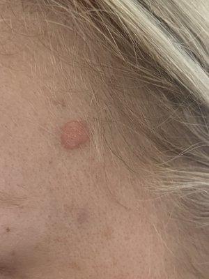 Skin, wisdom spot, Seborrheic keratoses