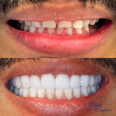 Cosmetic Dentist Full Mouth Rehab