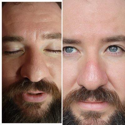 Sensitive-Nes Facial Before and After