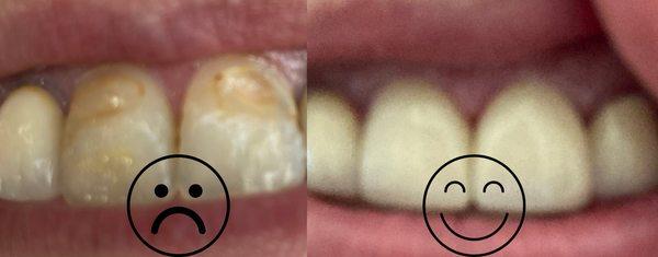 Front teeth crowns.