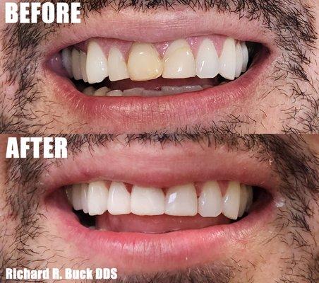 Cosmetic White Resin Bondings to fix the discoloration of previous fillings and teeth by Richard R Buck DDS