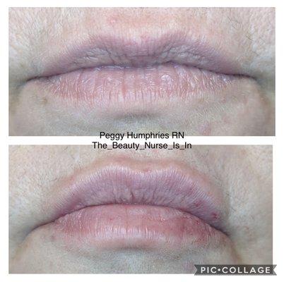 Lip Filler to enhance and restore shape and volume