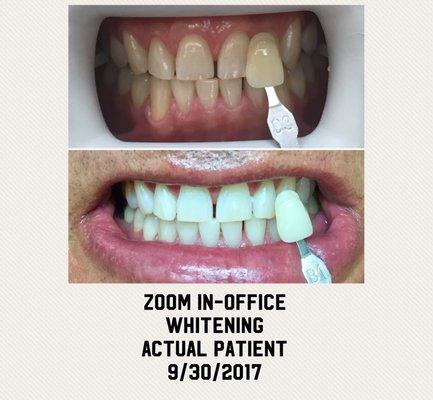 At Orange Tree Dental we offer Zoom in-office whitening. We have seen amazing results! Call our office if you would like to know more.