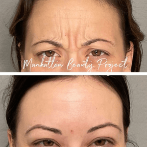 Relaxing the Glabella area for a smooth and youthful look.