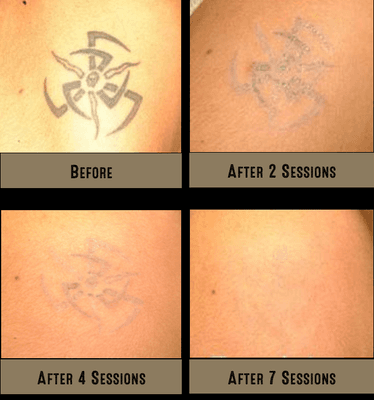 Series of 4 photos showing the complete removal of a shoulder tattoo in 7 sessions.