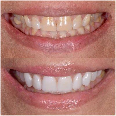 10 porcelain veneers on top and gum contouring