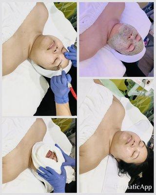 Microdermabrasion Facial.