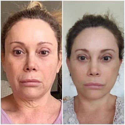 Before/ After. Face lift by Dr. Joseph.