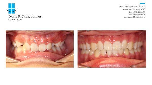 Deep Bite Correction