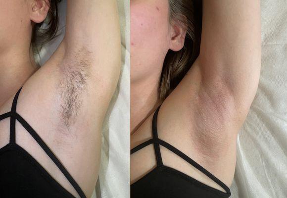 Before and after underarm hair removal with sugaring. Results that make you feel comfortable, not itchy, and less sweaty.