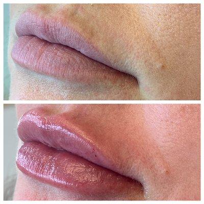 Lip filler with Restylane Kysse by Mary Gerlitz RN