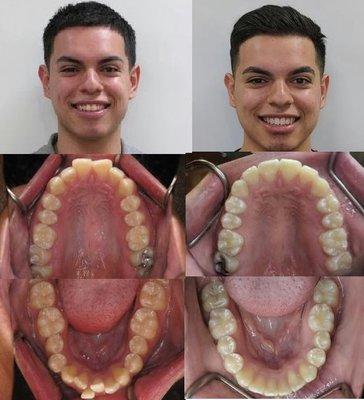 This patient was able to fix his alignment in under two years using clear ceramic braces!