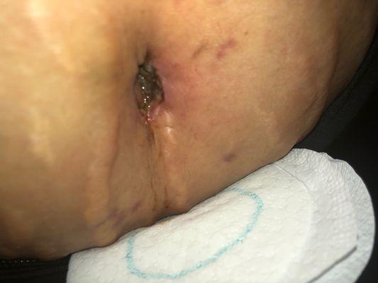 Infected bellybutton