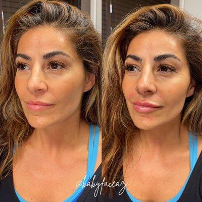 Revanesse lip filler Scottsdale, gorgeous results!