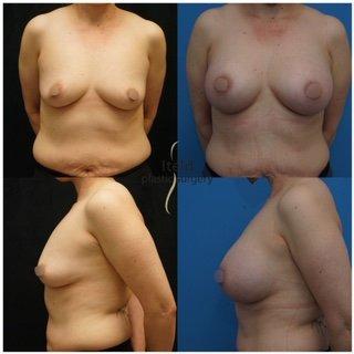 Breast Augmentation - Before and After