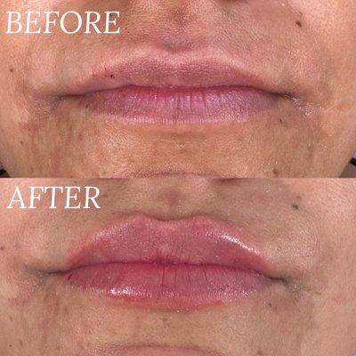 Natural aesthetic lip filler