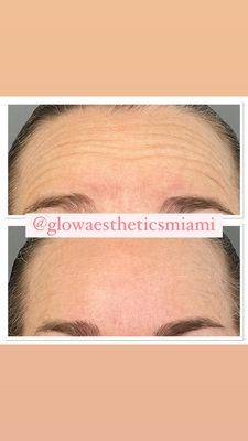 Botox treatment