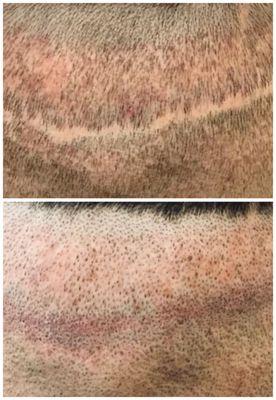 Scar camouflage from hair transplant