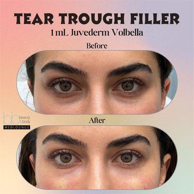 Under eye filler with Volbella