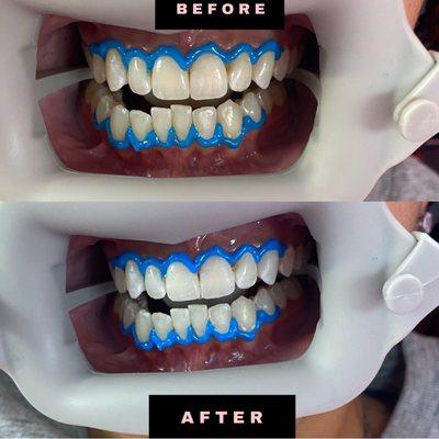 Cosmetic Teeth Whitening Session!