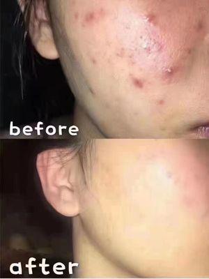 Acne treatment before and after