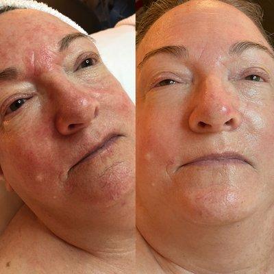 Rosecea facial for an even looking skin.