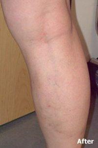 Patient 8 - varicose vein treatment AFTER