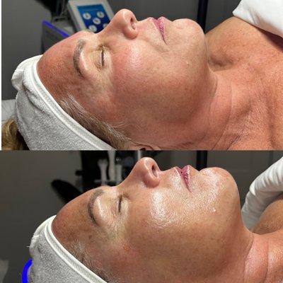 Immediate Results After ONE Customized 60 Minute Facial + Dermaplaning Add On