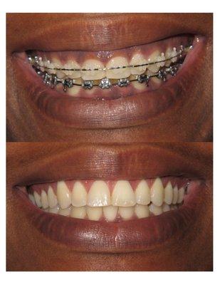 Esthetic Crown Lengthening while in orthodontic treatment.