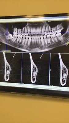 X-ray of my wisdom teeth!