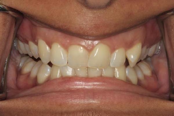 Invisalign Before