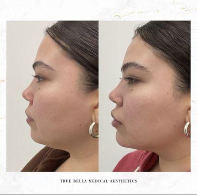 Facial Balancing by doing Massetter Botox and Chin Filler