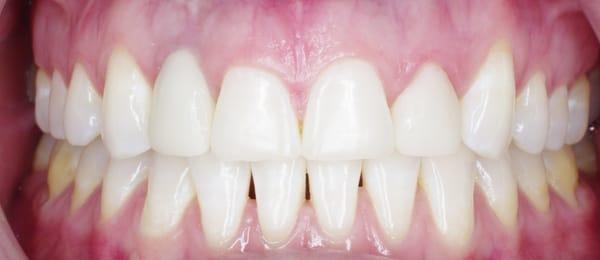 Uneven gingival contours and teeth.