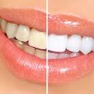 Teeth Whitening