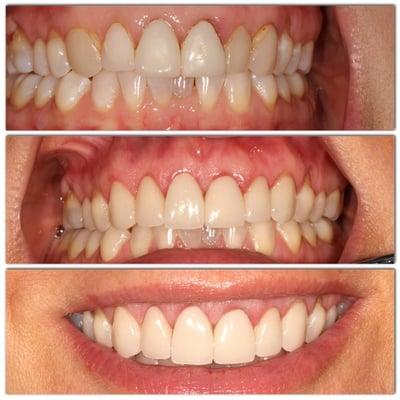 Julia's (who is now all smiles) transformation! Dr.Johnson restored her six front teeth.