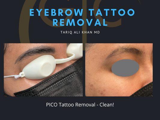 Eyebrow Tattoo Removal - We do Lots of these!!