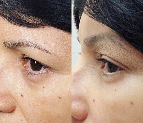 Plasma Lift (fibroblast)
Day 2 - Addressing Hooded Eyelid Problem