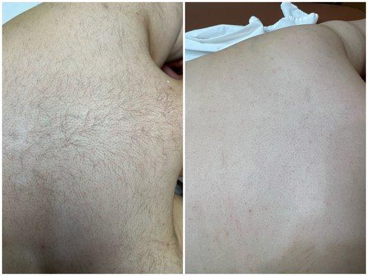 Laser hair removal: Before and After