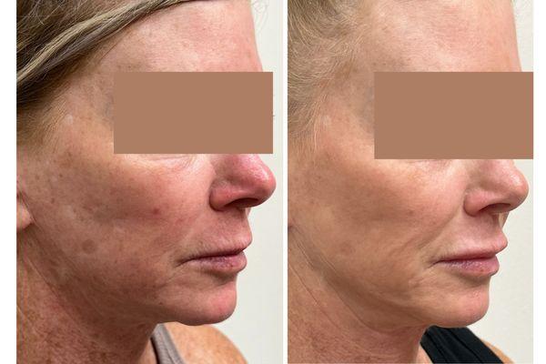 Before 1st & after a series of 3 Potenza Radio Frequency Microneedling treatments for face and neck