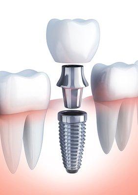 From bottom to top; implant, abutment and crown.