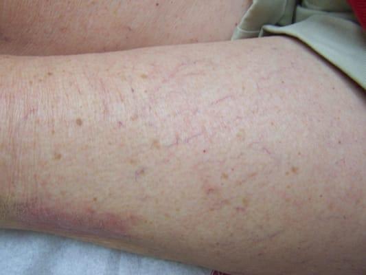 After Sclerotherapy treatment for spider veins.