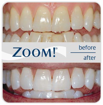 Try our at home or in office teeth whitening systems.