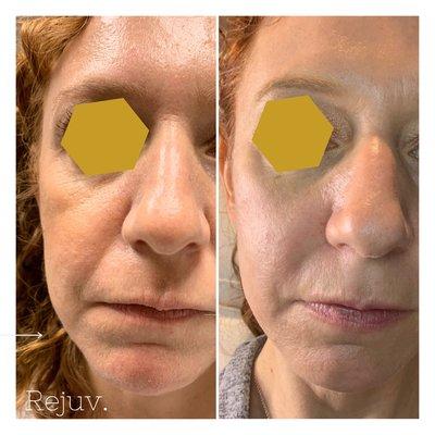 Facial filler augmentation