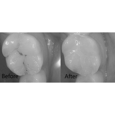 Cavity filled by Dr. Hine that was causing tooth pain and sensitivity