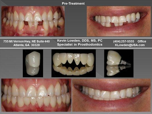 Traditional Crown & Bridge Fixed Prosthetics