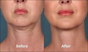 Kybella before and after